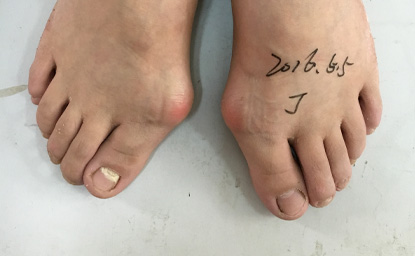手术拇外翻后会反弹吗
